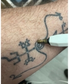 Thumbnail image 3 from Hair Removal Specialists Surrey